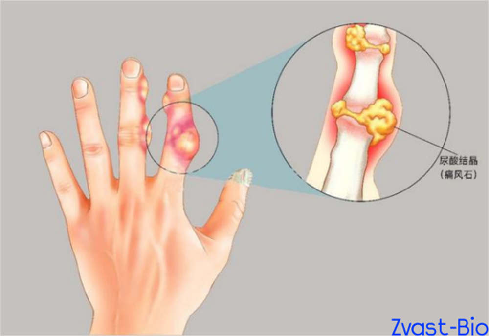 New Gout Drug! Advancing Global Phase 3 Clinical Trials to Fill Treatment Gap