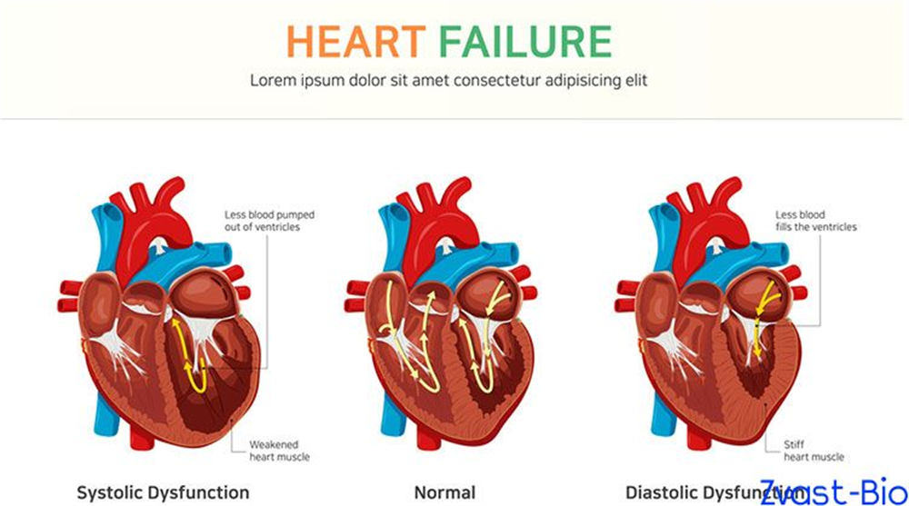 Treatment for Chronic Heart Failure, Salubris JK07 May Break the Deadlock！