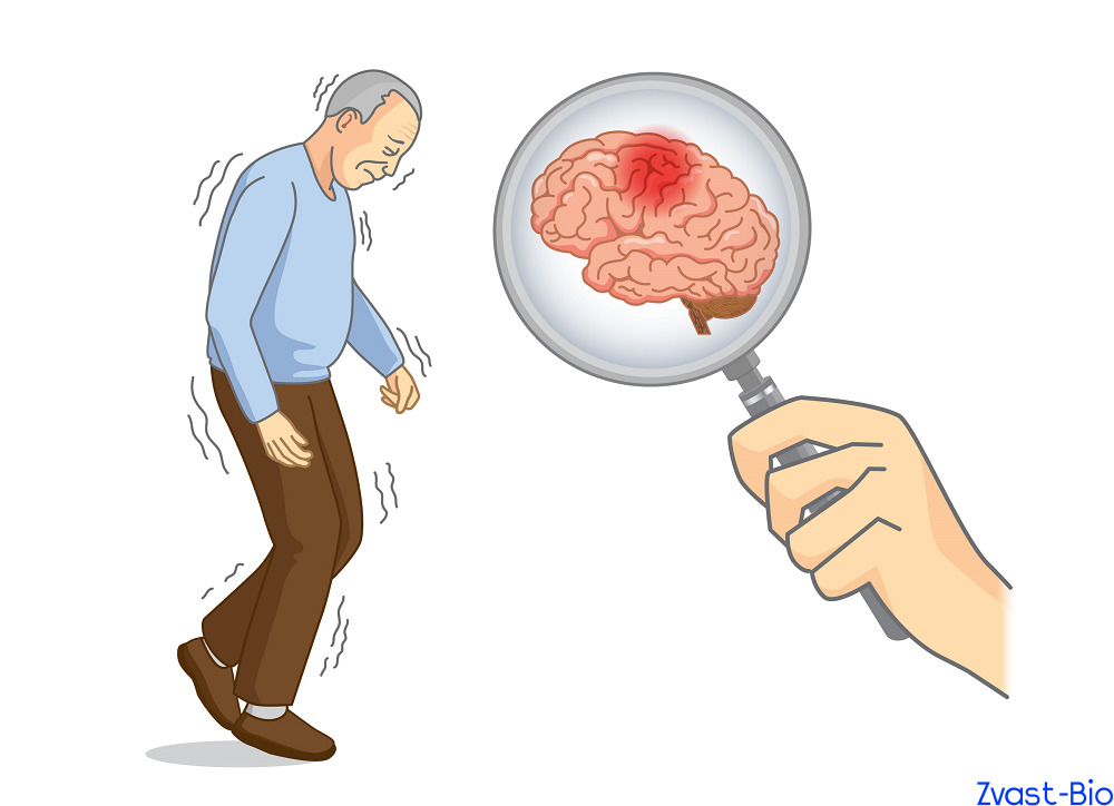 Parkinson Disease Is No Longer a Hopeless Condition: How Far Have We Come from Levodopa to Stem Cell Therapy?
