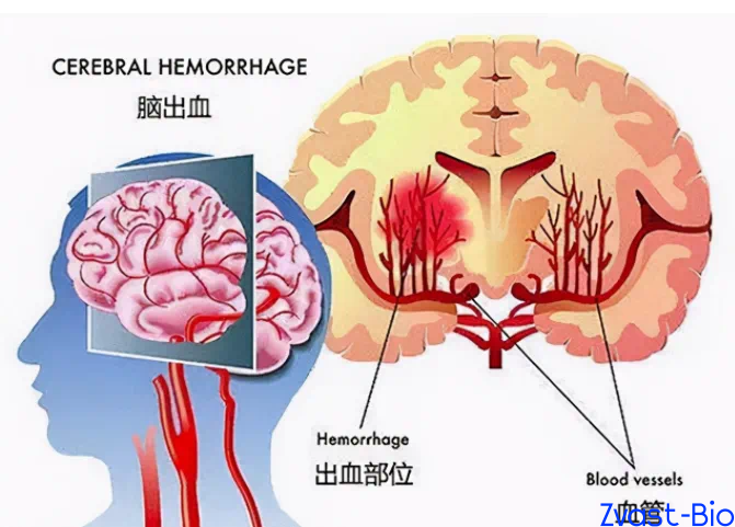 Hope for Millions! Disruptive Breakthroughs in Cerebral Hemorrhage Treatment&mdash;Innovative Approaches Rewrite Prognosis