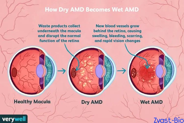 how-dry-amd-becomes-wet-amd-4770108-209bcafcdd694d5f85bdd5f15d3a61a9.jpg