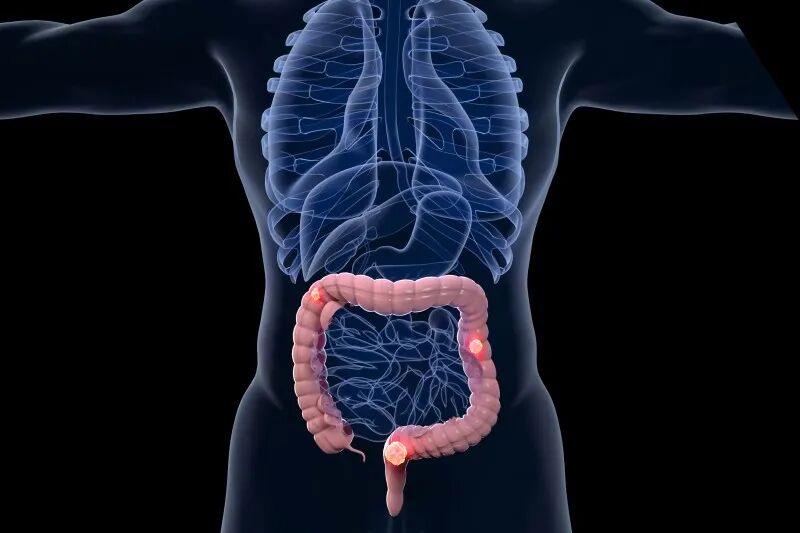 900,000 deaths each year! From incurable to complete clinical remission, colorectal cancer treatment is ushering in a paradigm shift